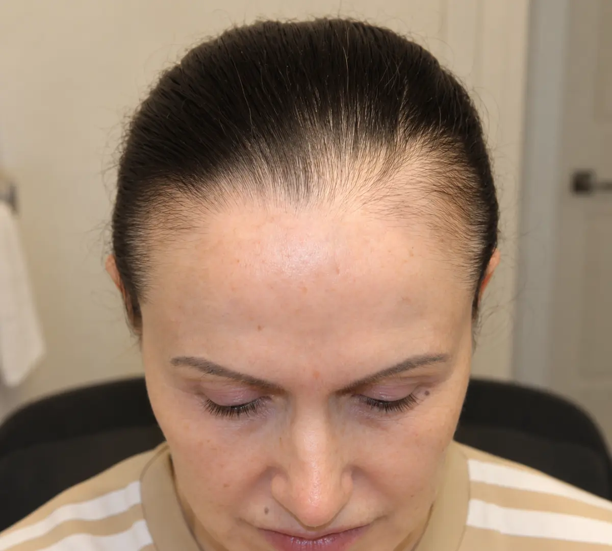 Jessica L. before using Pepthair